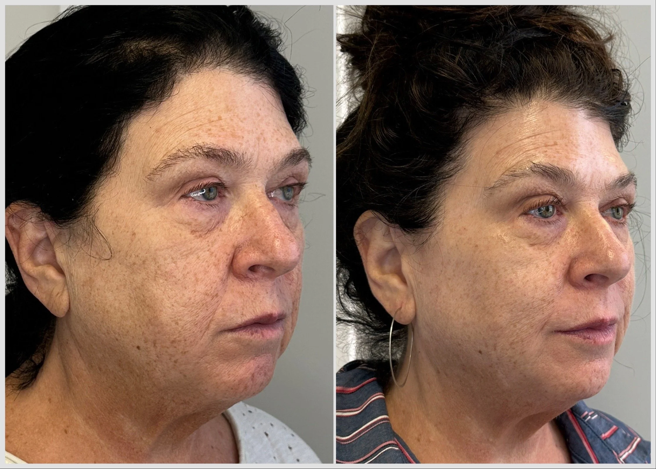Series of 5 PRX  Derm Perfection