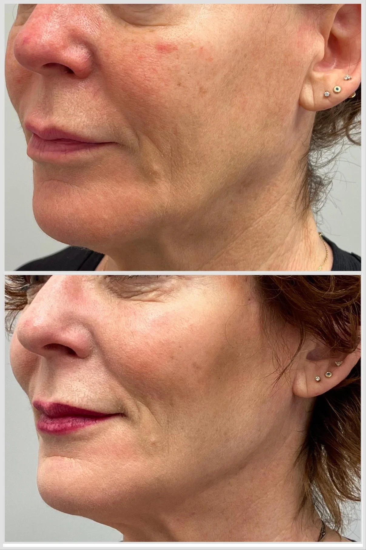 Lifting Threads placed to gently reposition and support skin along jawline.