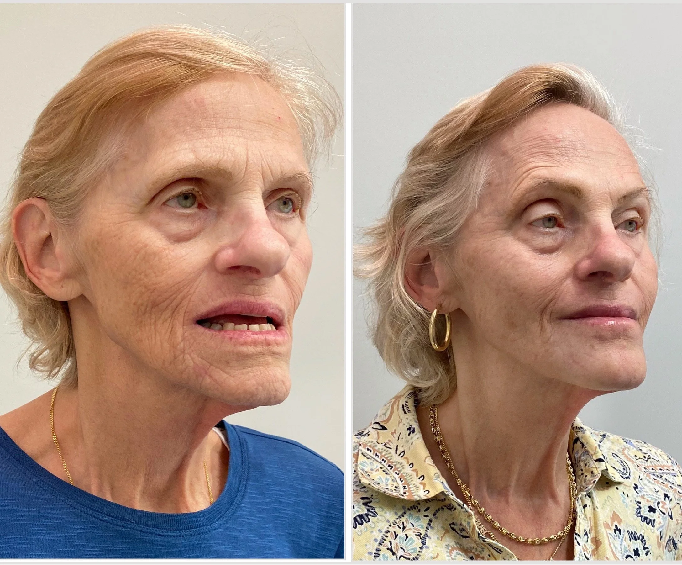 Full-face filler and expertly placed Botox to restore volume loss and facial balance.