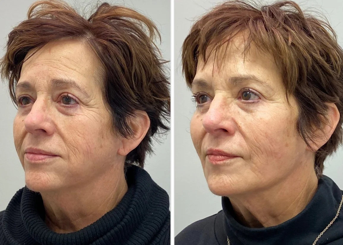 Full-face dermal filler to restore balance and lost volume.