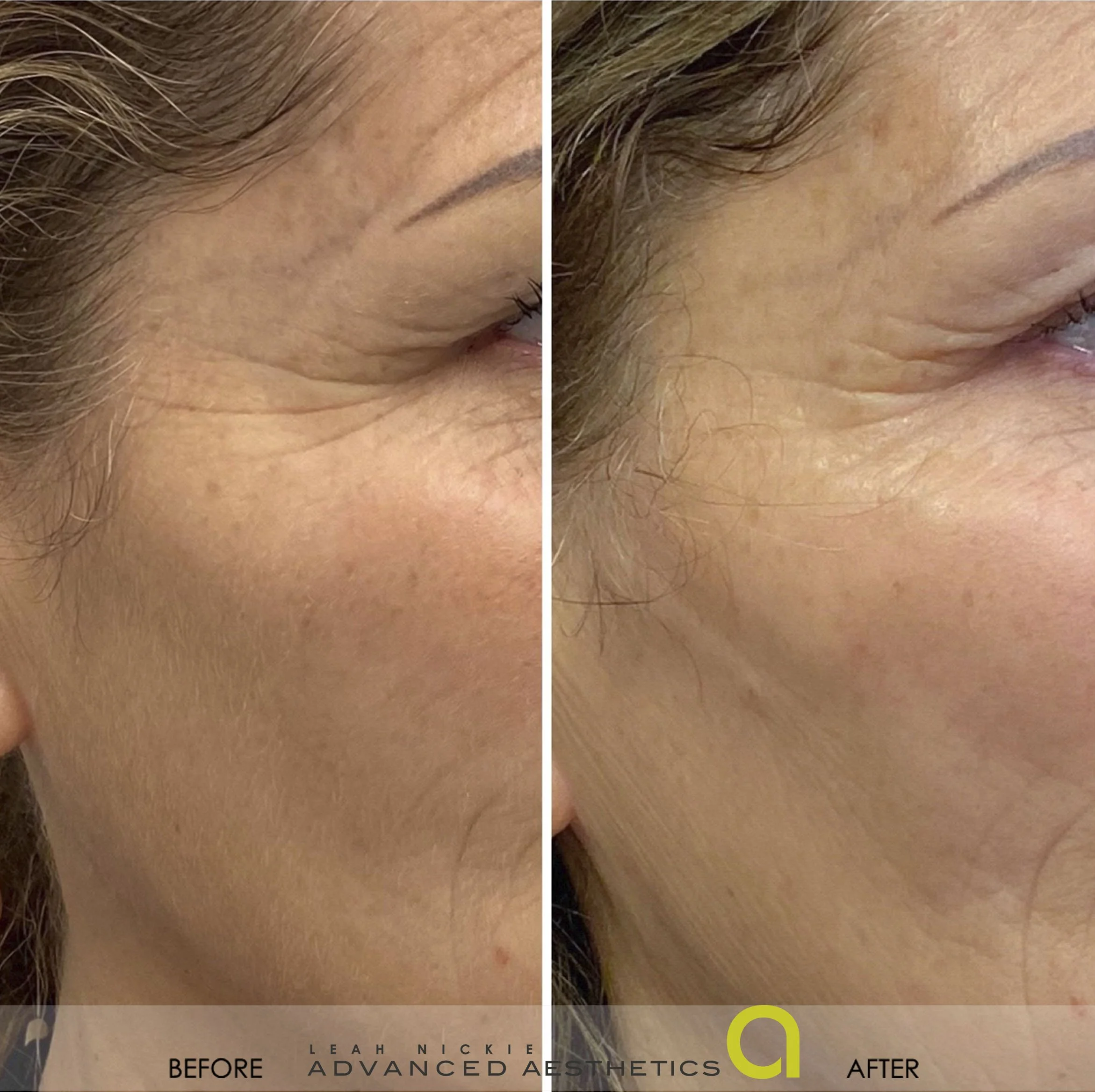 Series of 4 PRX  Derm Perfection