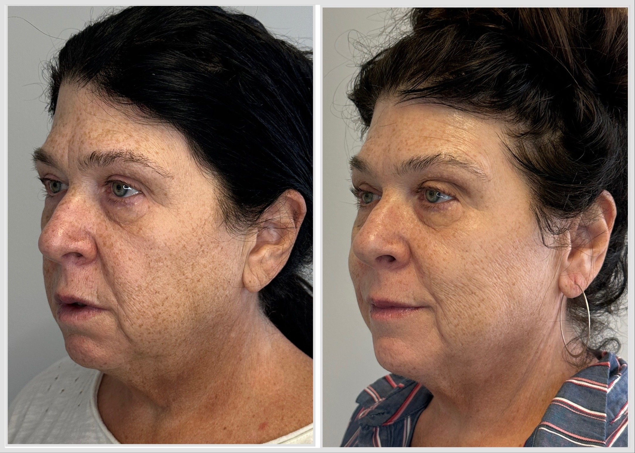 Series of 5 PRX  Derm Perfection