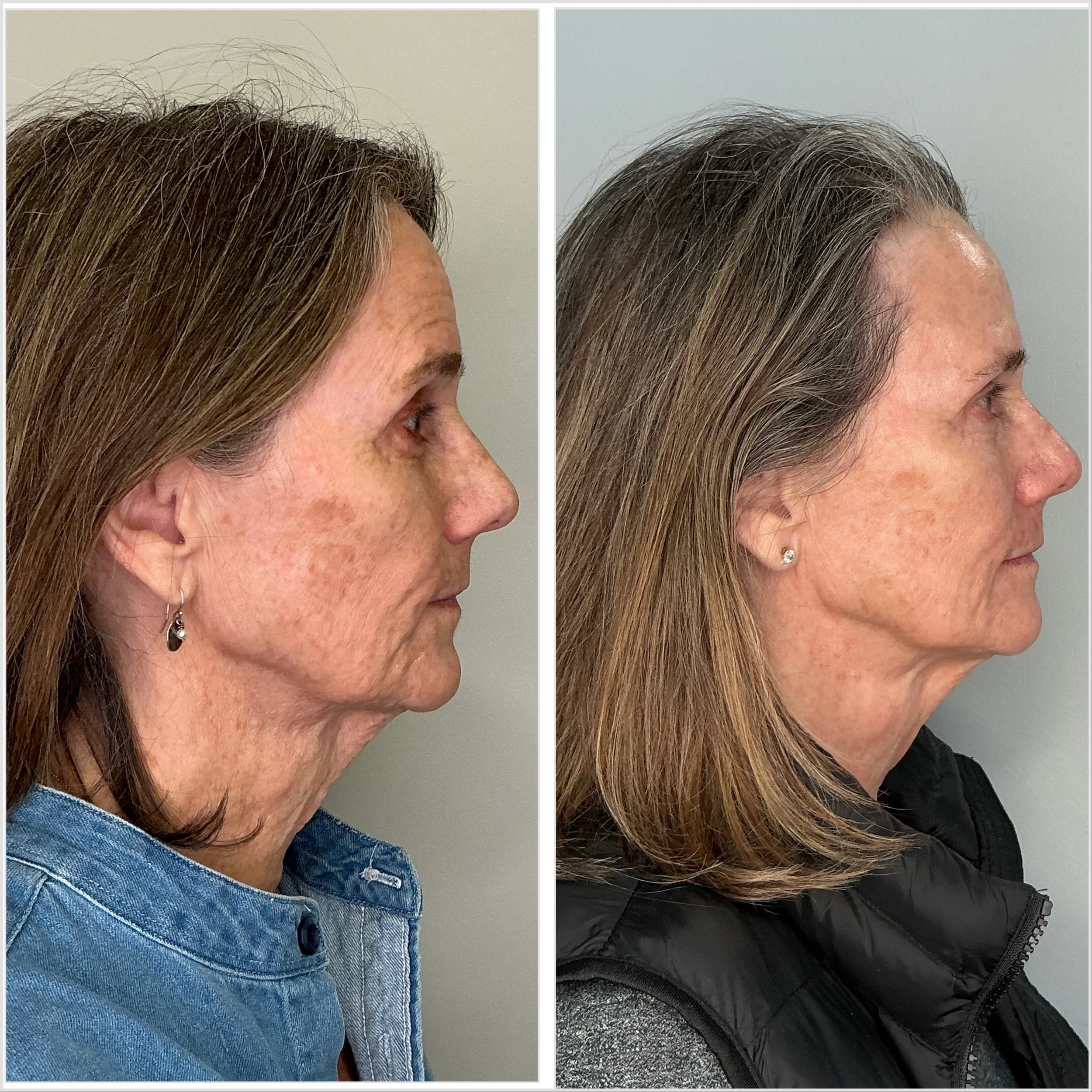 Two PCA Chemical Peels