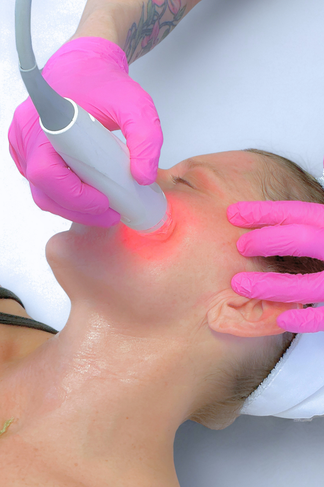 Ultrasound-Guided RF Microneedling in Boulder: A More Precise Way to Improve Skin Texture and Tone