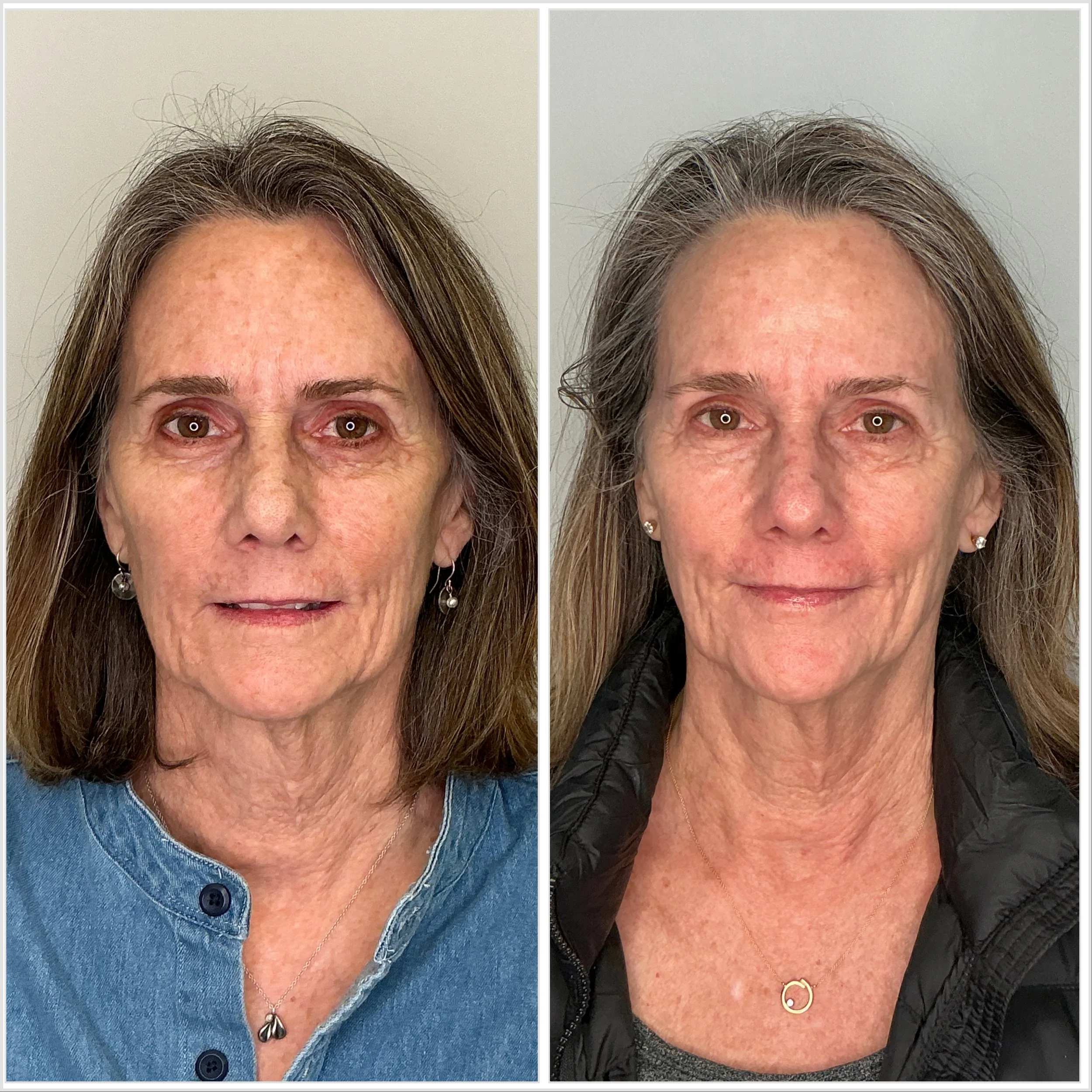 Two PCA Chemical Peels