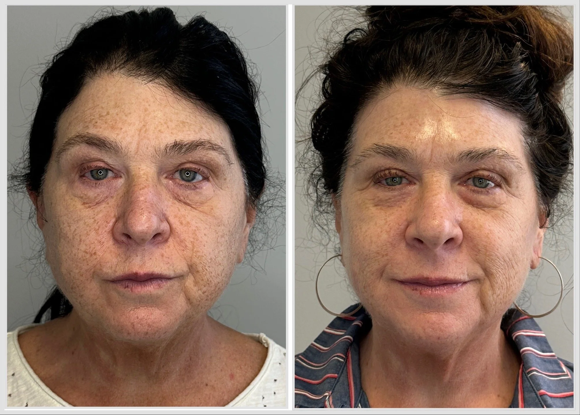 Series of 5 PRX  Derm Perfection