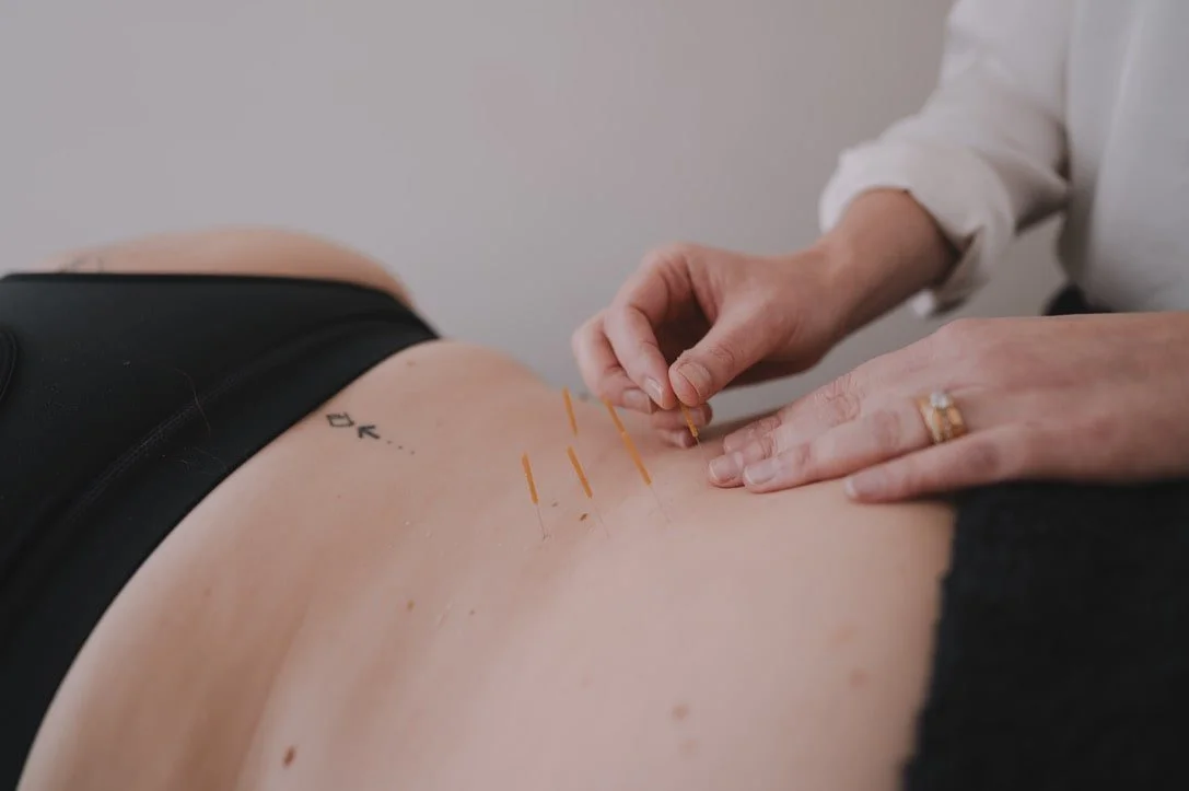 Physio Lilydale Dry Needling.jpeg