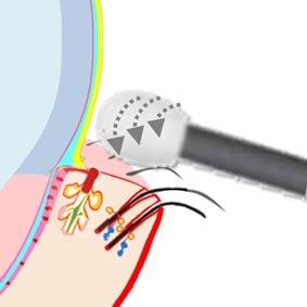 Mechanical Cleaning (BlephEx)