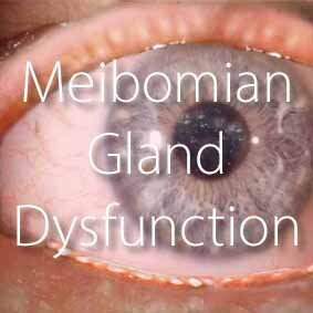 HOME-Eng_LINK BILDCHEN_MEIBOMIAN Gland Dysfunction (MGD)_.jpg