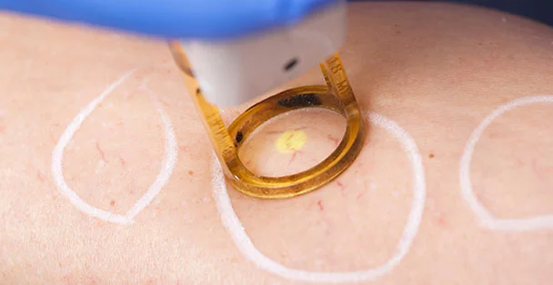 Laser-Vein.jpg