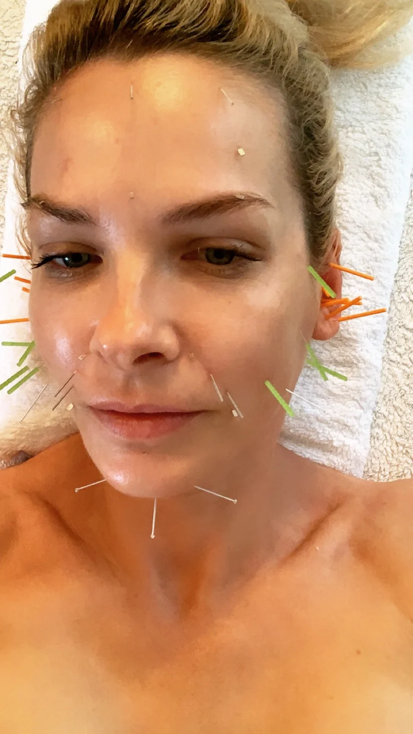 Face Acupuncture by Sarah Bradden