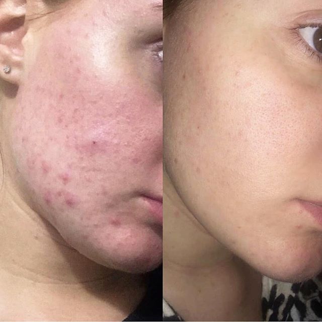 SKIN JOURNEY || repost from @asapskinproducts 🥰 || Having struggled with medications to try and fix her skin, this gorgeous client then turned to @asapskinproducts || Using them consistently morning and night, drinking plenty of water each day and m