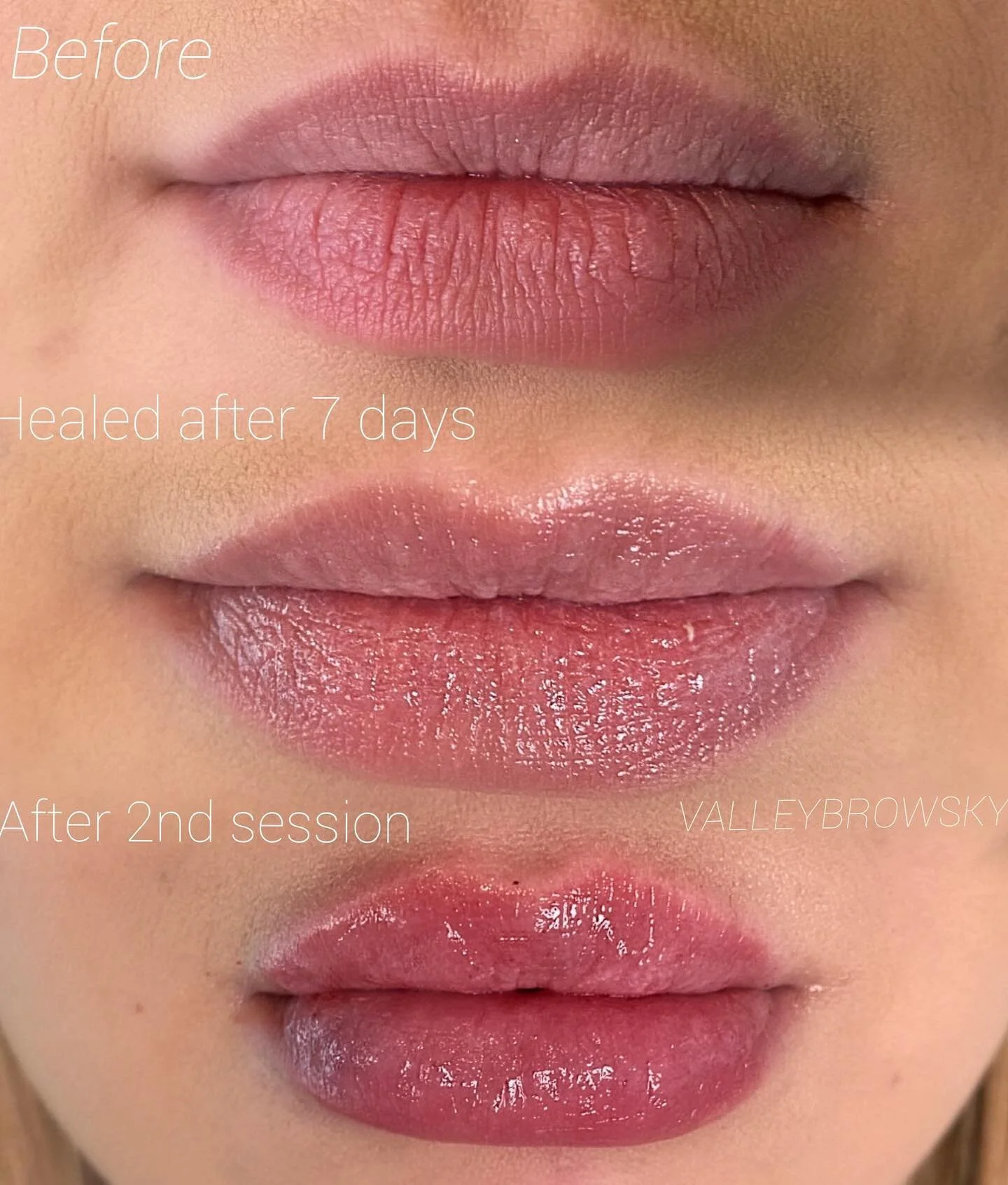The perfect pout with 2ML is giving us VOLUME 💋 we started out very conservative the first session because we wanted to add lots of volume the second session! 

Redness and bumps are common the first 24hrs, occasional bruising can occur

#valleybrow