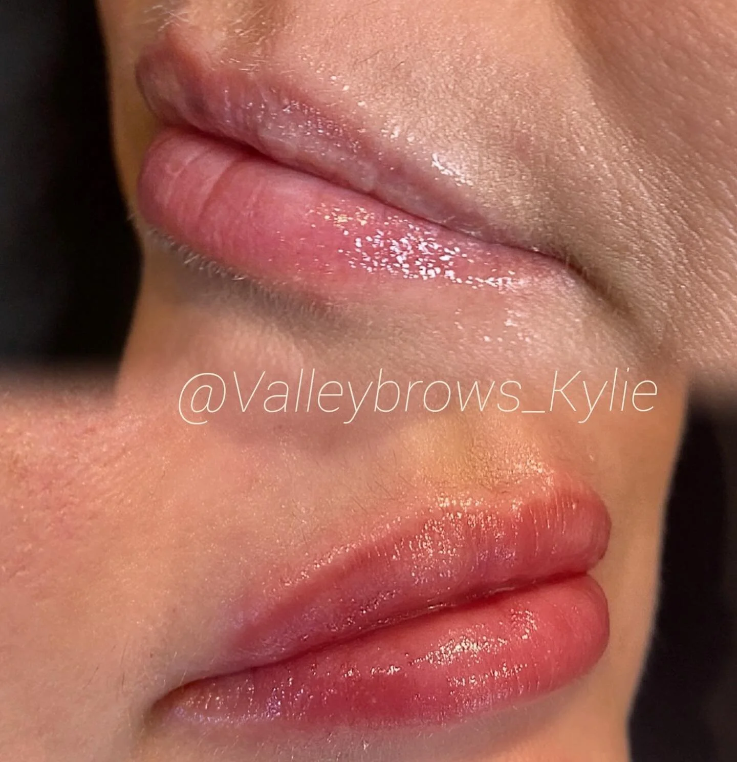 1 Ml of filler for the perfect pout 💋

#valintinesday #valentineskiss #biglips #naturallips #lipfiller #hayapen #hyaluronpen #sonoma #napa #petaluma #bayarealipfiller #needlefreefiller #bayarea #valleybrows #valleybrowskylie