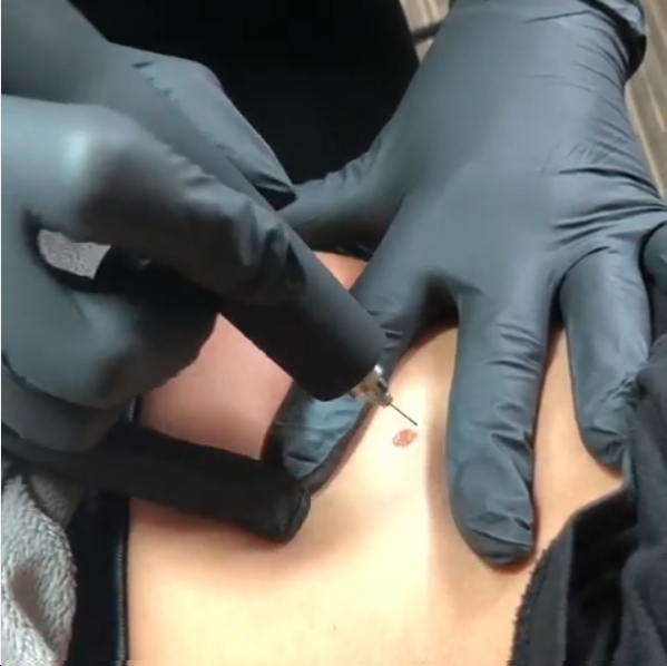 Mole removal