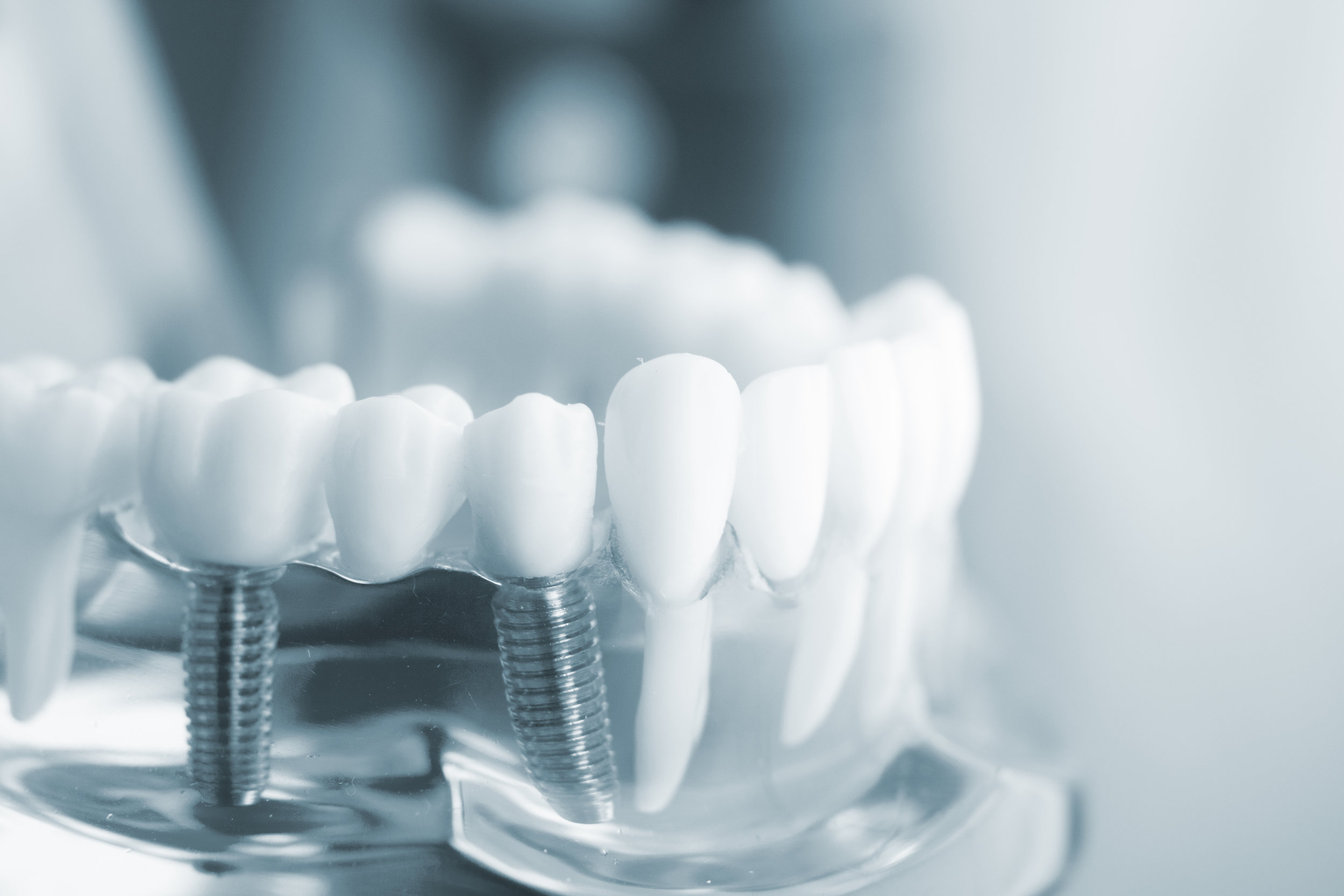 DENTAL IMPLANTS