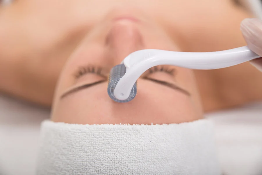 Patient receiving integrated acu-microneedling treatment during acupuncture