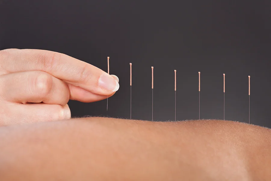 patient receiving dry needling from trained acupuncturist