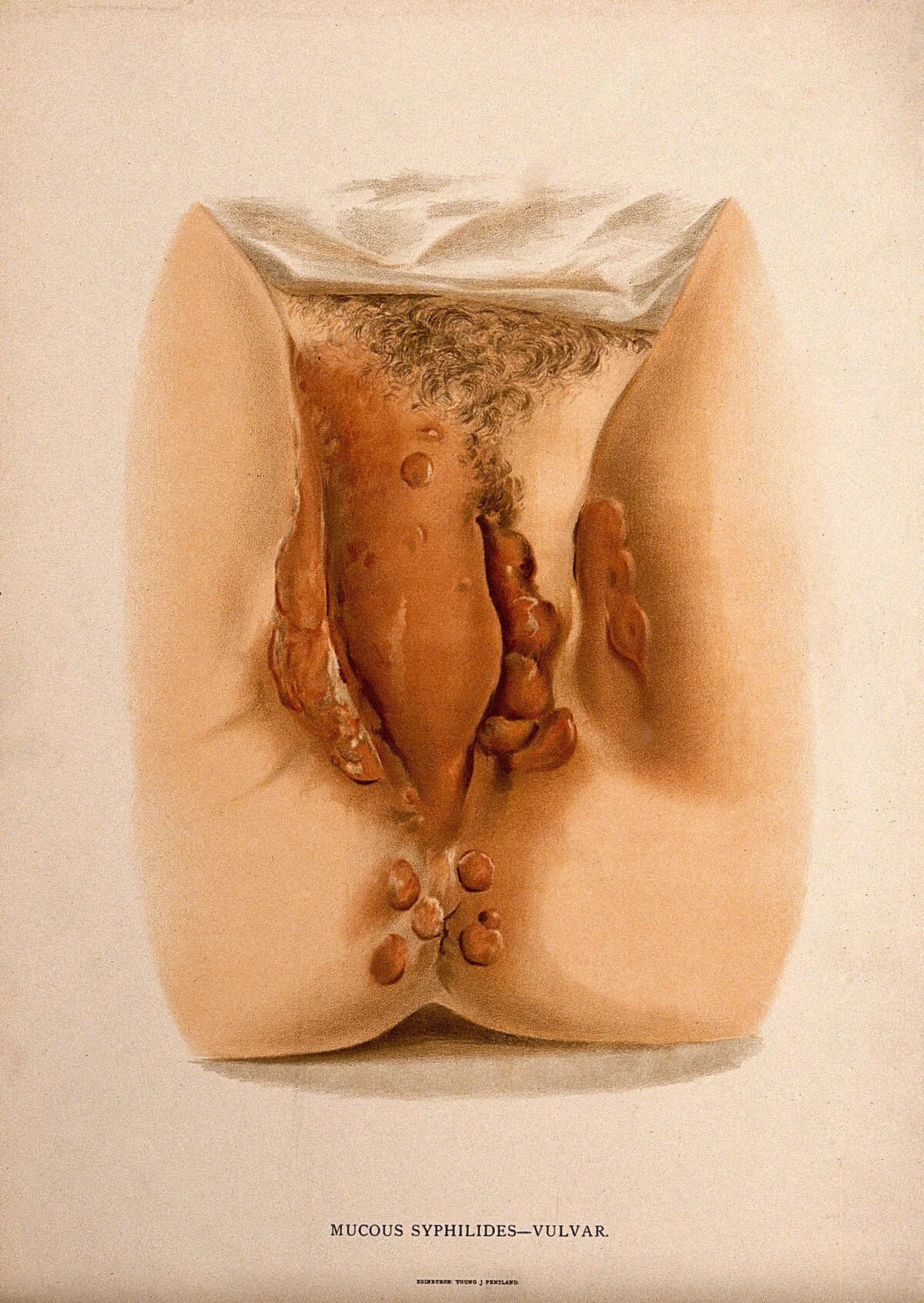 Female genitalia with a skin disease around the labia and the anus. Chromolithograph, c. 1888. Wellcome Collection..jpg