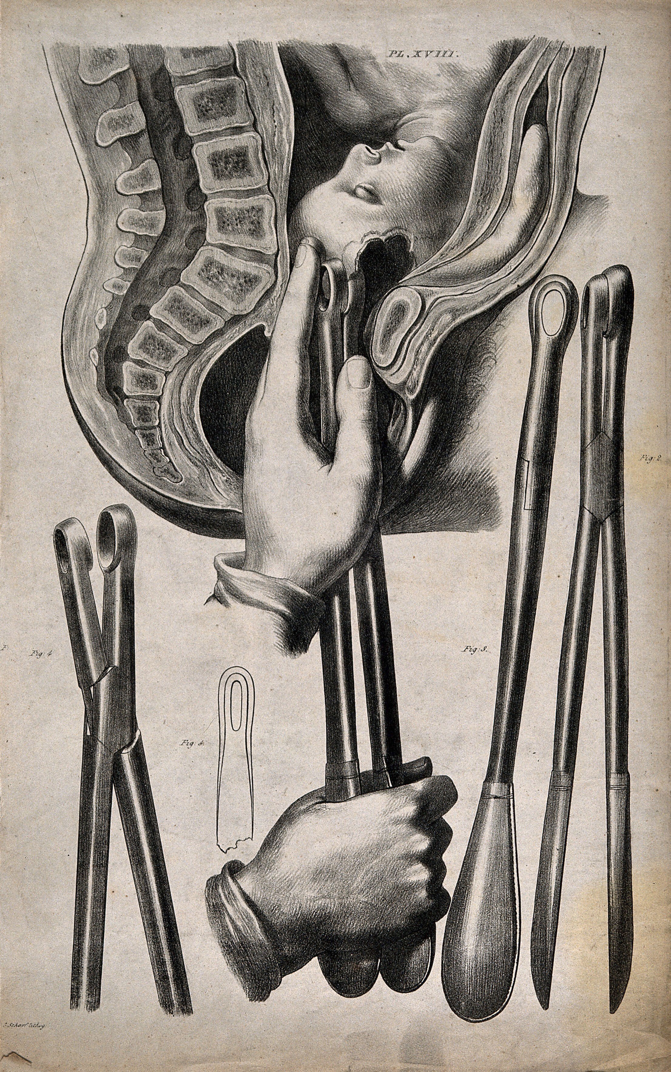 A diagram demonstrating different kinds of forceps, and their use in childbirth. Lithograph by G. Scharf. Wellcome Collection..jpg