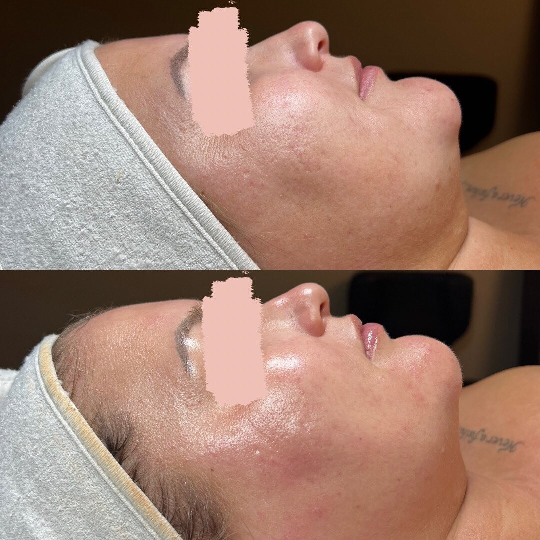 Have you exfoliated lately?! Regular exfoliation is key to amazing skin! Here we did our signature Hydroglow Hydrofacial and look at that glow! This facial is stacked with our favorites. Enzymatic exfoliation, water vortex cleansing of the pores, ext