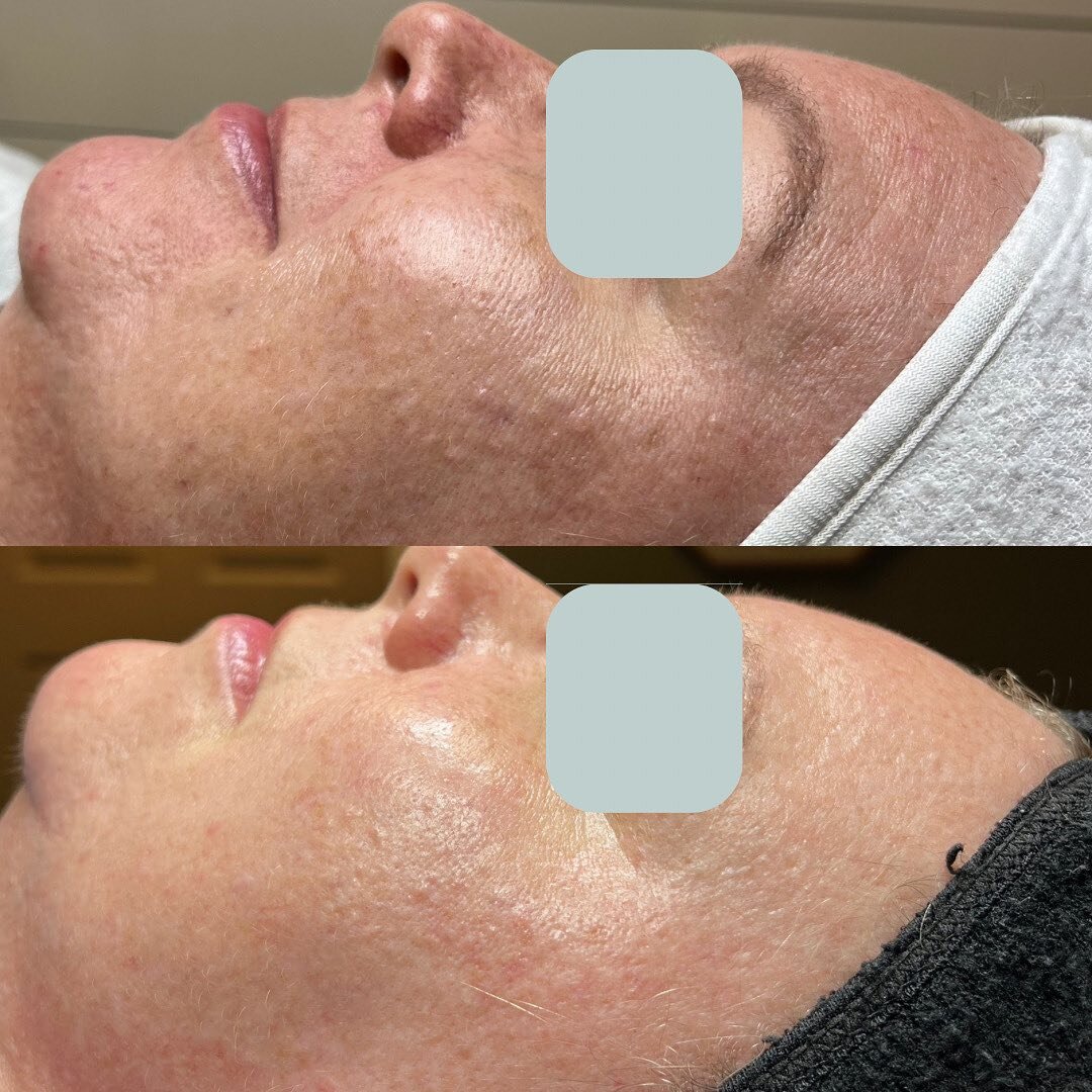 This client we started back in November when peel season hit! Obsessed with peels btw. We upgraded her skincare routine with tyrosinase inhibitors and very high quality vitamin c. We wanted to hit it hard to get rid of the pigment and even her skin t