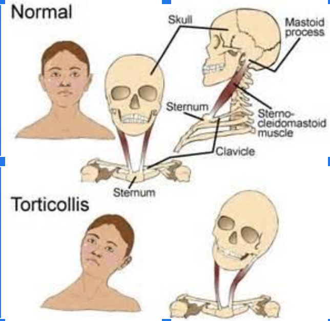Babies with Flat Head, Tight Neck (Tortocollis and Plagiocephaly) and