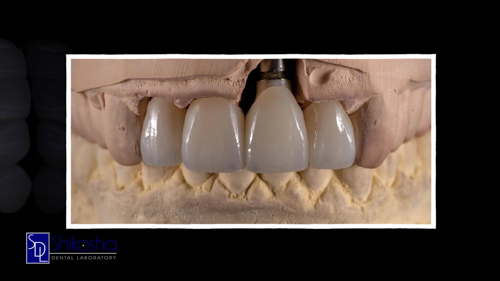  ZR100™ Full-Contour Zirconia  Shikosha's exclusive ZR100™ Full-Contour Zirconia line features Classic, Premium, and High Translucency zirconia. 