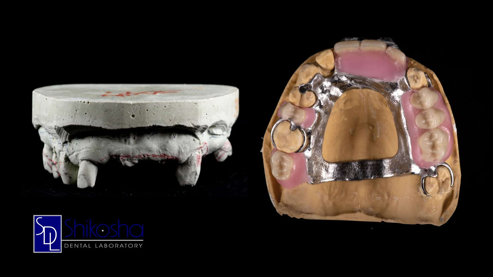  Cast Metal Partial Denture  Metal framework and clasps connect securely and comfortably to your patients’ teeth. 