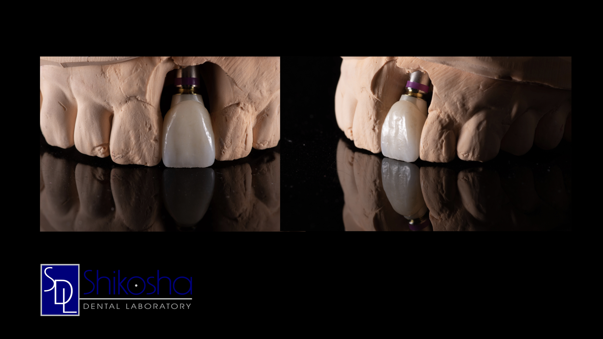  E.max Implant Crown  E.max Implant Crown with a Zirconia-Titanium Hybrid Abutment 