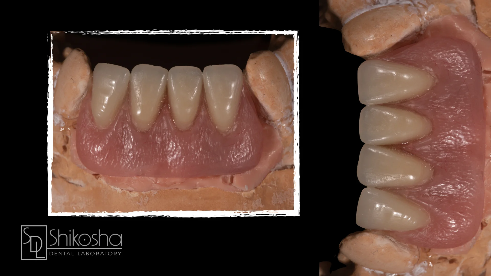  T:Loc Overdenture  Hybrid Case using TruAbutment’s T:Loc custom denture abutment. 