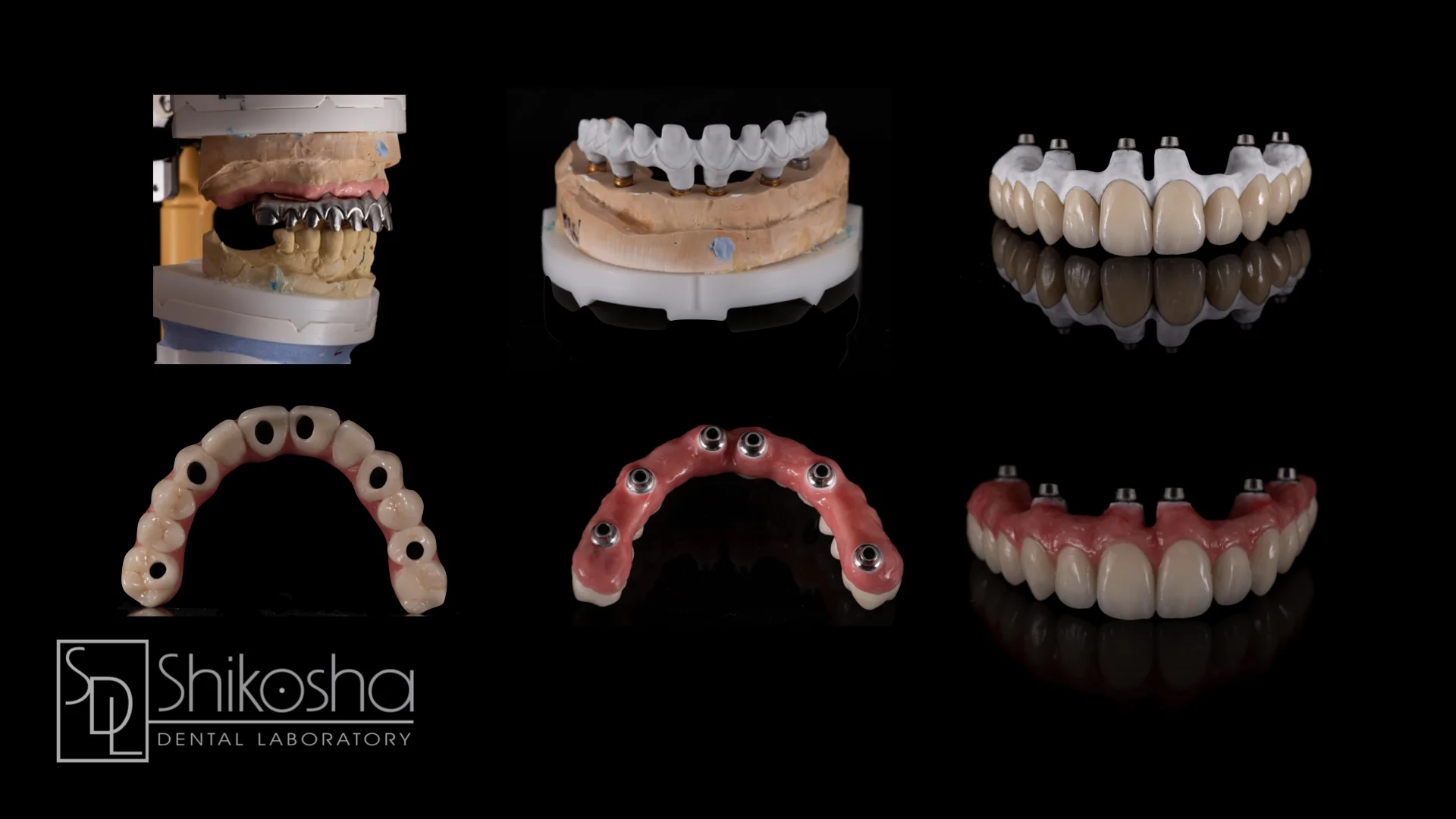  Titanium Hybrid Case  Step-by-step process of titanium hybrid case with composite gum, made with a titanium frame and all-ceramic crowns. 