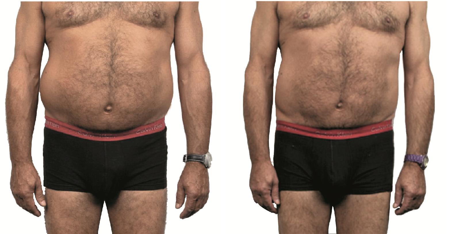  before and after man torso endermologie 