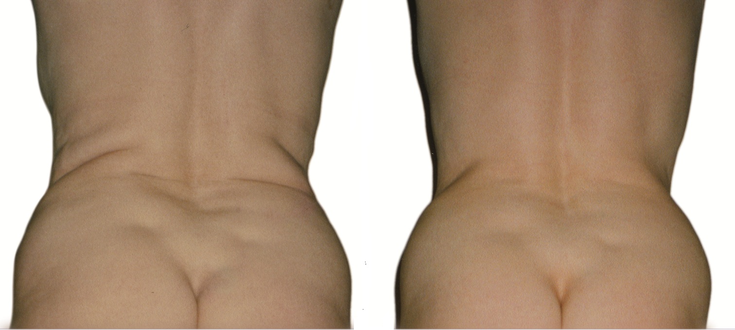  before and after woman muffin top endermologie 