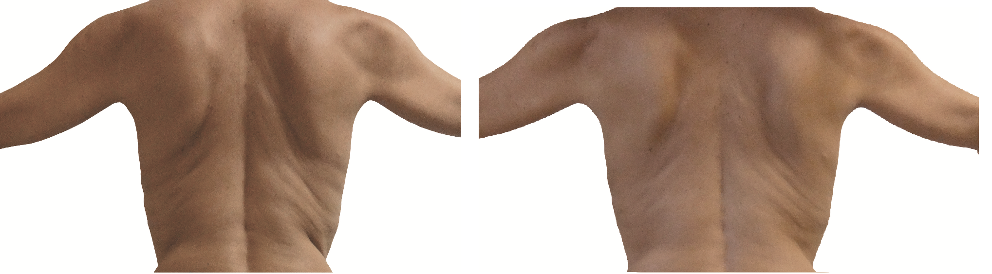  before and after man back endermologie 