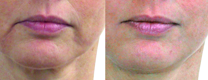 Lips_43 ans_12 sessions_Endermolift.png
