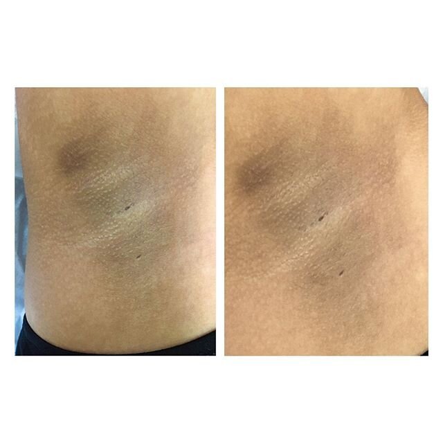 We had a client with ashy underarm discoloration. This was taken after just ONE session of laser therapy. A lot of times, underarm hair removal is effective but the area still looks dark because of underlying skin discoloration. With the use of addit