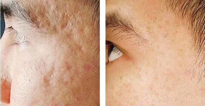 Co2 Fraxel before and after Acne Scar.jpg