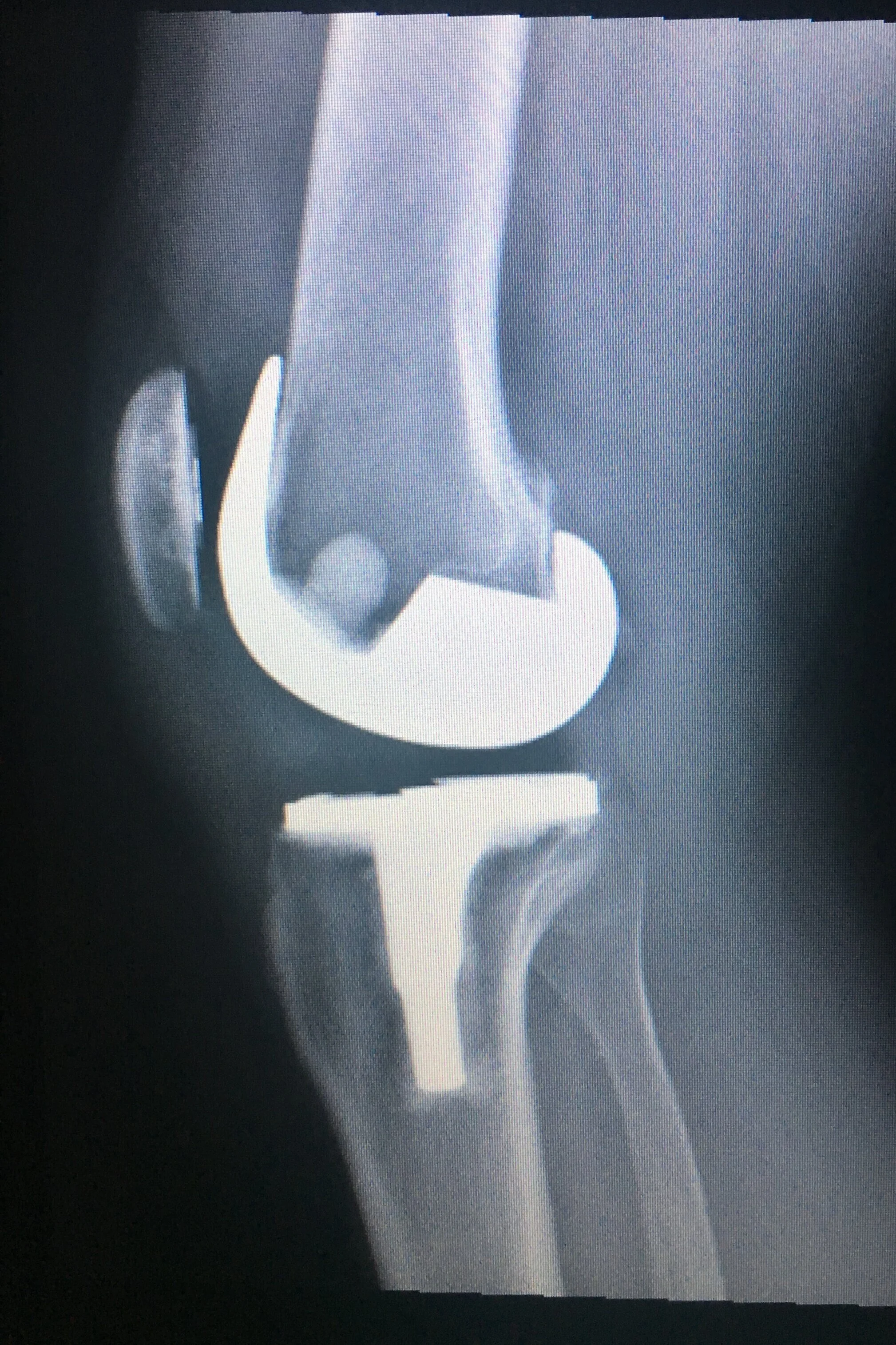 This is a lateral projection of my knee about a 10 days after surgery. It is still incredible to me that it’s actually inside my leg, works perfectly and has allowed me to walk, not only to Virginia today, or up Pikes Peak a couple of months ago, Th…