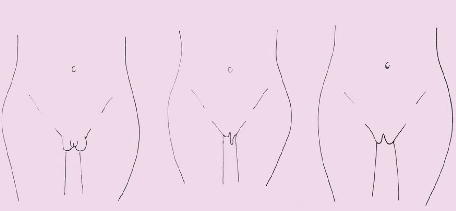 Vulva Shapes