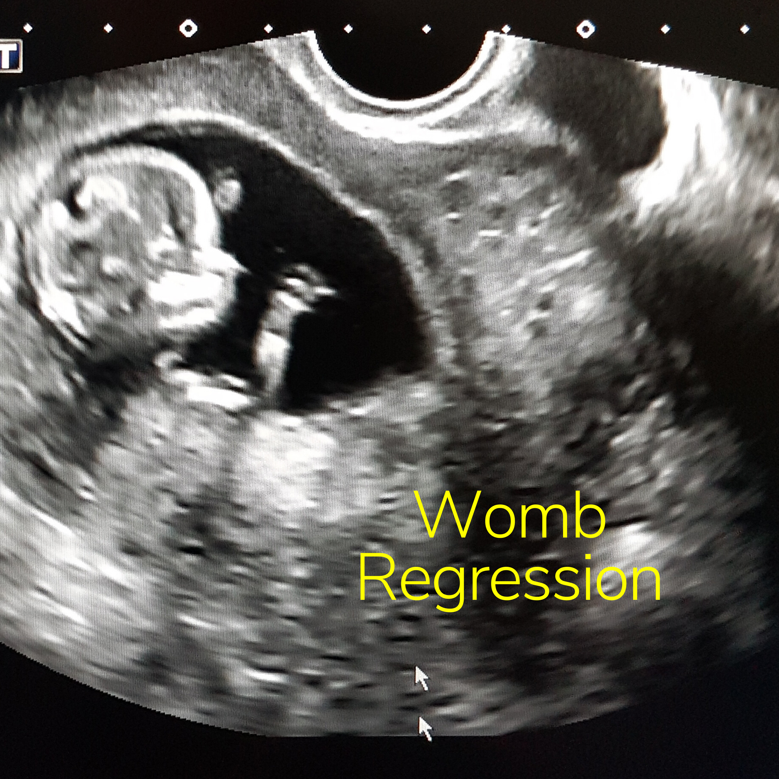 Womb Regression