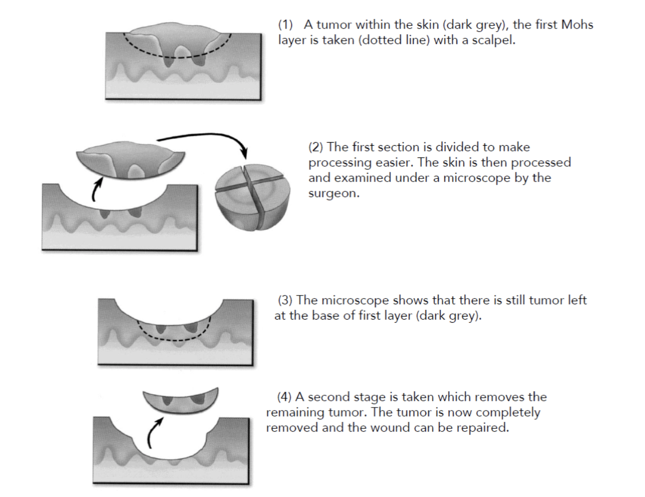 Mohs Surgery Information — Reflections