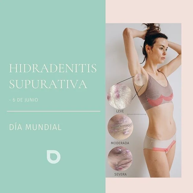 🔺Hoy en  el día mundial de la Hidradenitis supurativa, quiero compartirles esta información importante , sobre esta enfermedad: 
_
▪️Qué es? 
La Hidradenitis supurativa o acné inversa, es una enfermedad inflamatoria crónica de los folículos pi