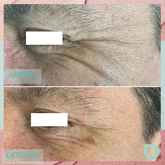.
🔹Uso de la toxina botulínica en 👨🏻
.
🔹Cada vez más hombres se realizan este tipo de tratamiento , con el fin de refrescar y rejuvenecer su aspecto  sin perder su naturalidad .
.
🔹En este caso usamos, #toxinabotulínica 💉en las  líneas de e