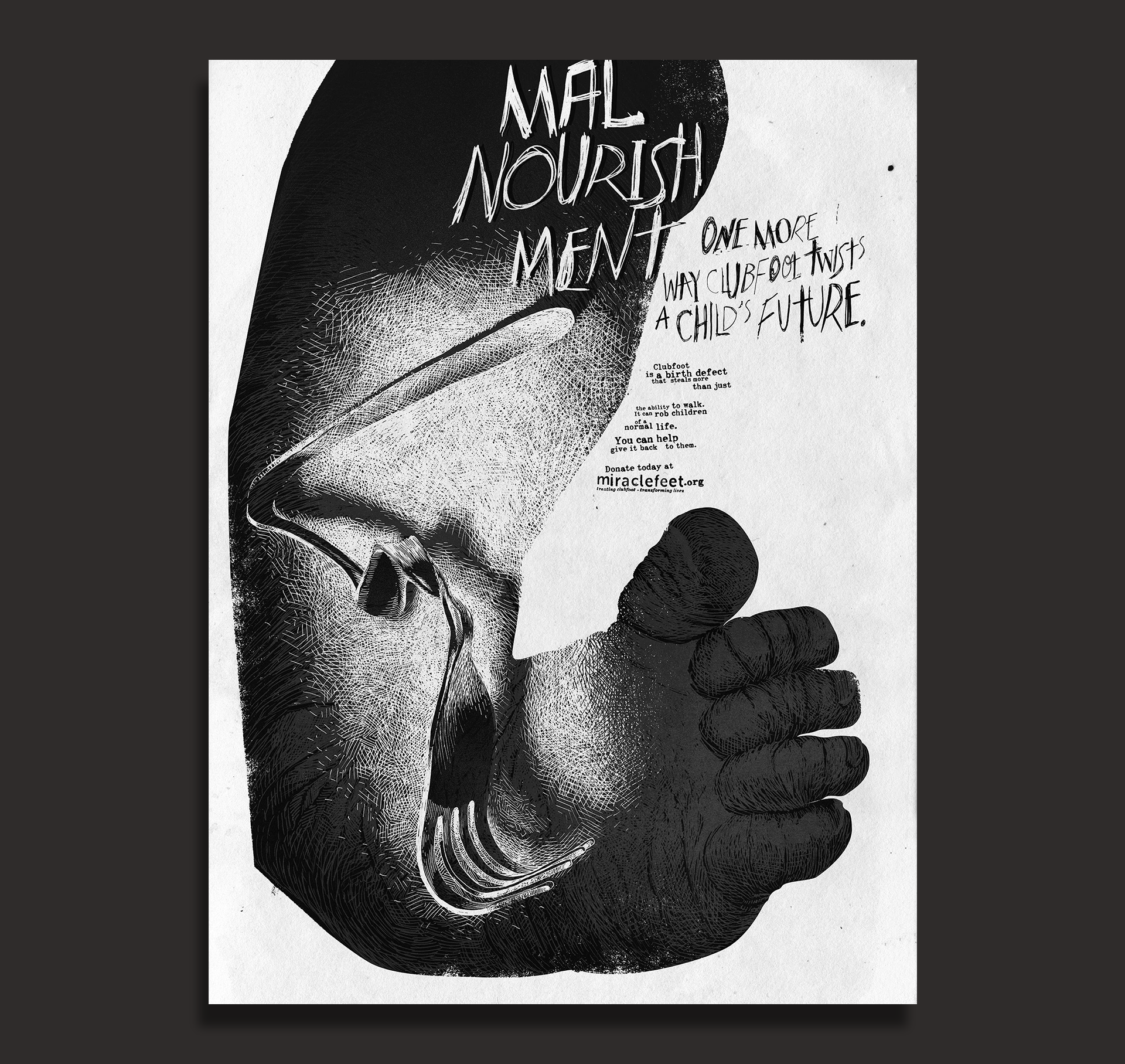 004 clubfoot malnourishment.png