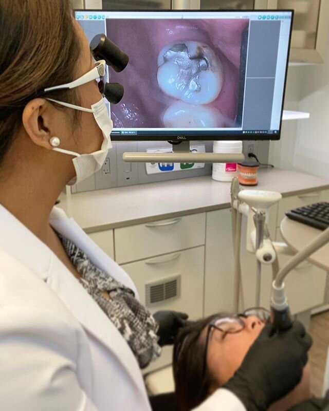 Thanks to technology, I can capture the smallest details in the most hard to see areas of your mouth and share it with you. I always take lots of pictures for my records because, well, a picture is worth a thousand words.
.
#stocktonca #moderndentist