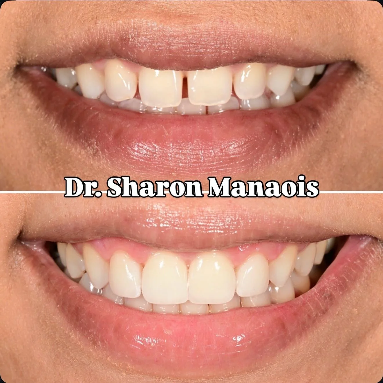 When your smile radiates confidence, anything feels possible. 💫

Here is four No-Prep Veneers to bring this smile to the finish line 😍

Ceramics by @v_smile_design 🔥

#stocktonca #209dentist #smilemakeover #noprepveneers