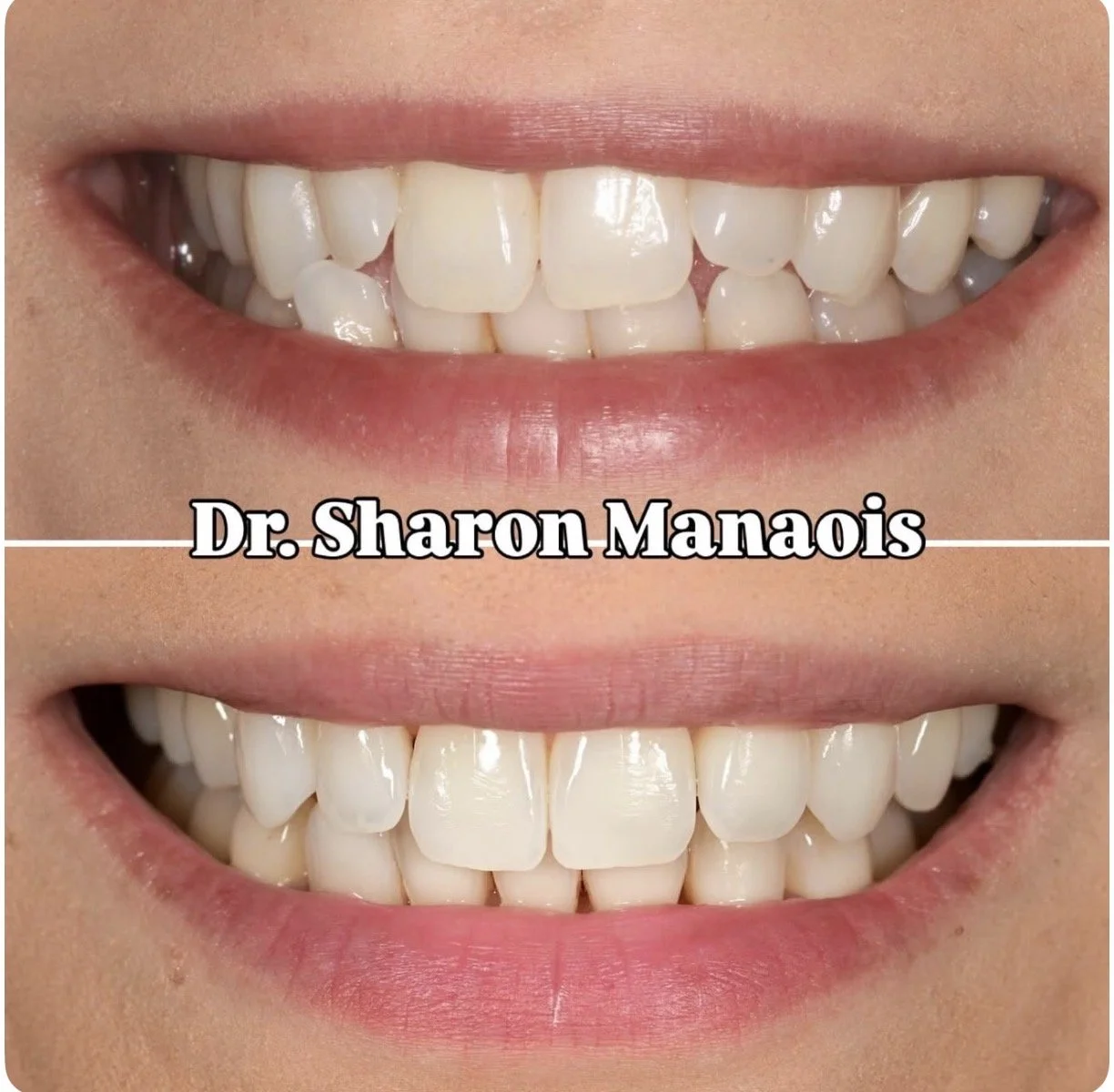 Invisalign