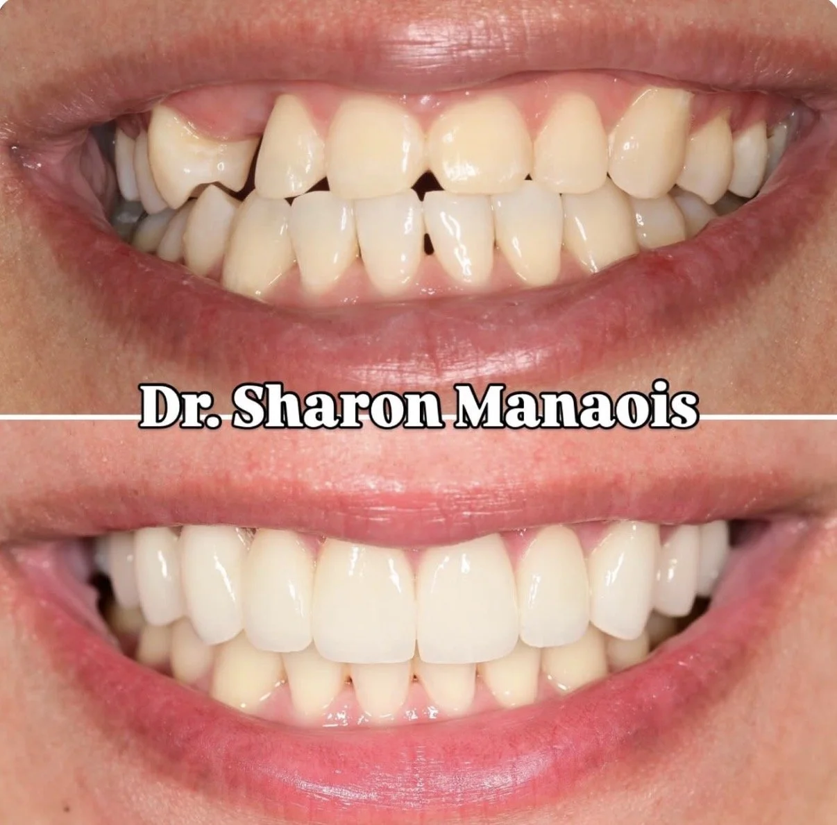Veneers, Bridge