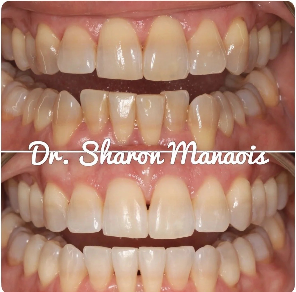 Tetracycline Whitening